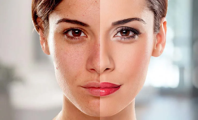 skin rejuvenation treatment