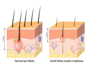 Hair Regrowth Treatment